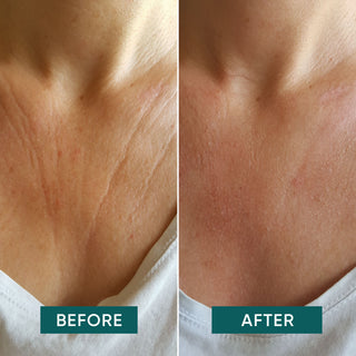 Ein Vorher-Nachher Vergleich eines Decolletes nach der Anwendung des Decolletes Vitamin C Pad der Marke Apricot Beauty.